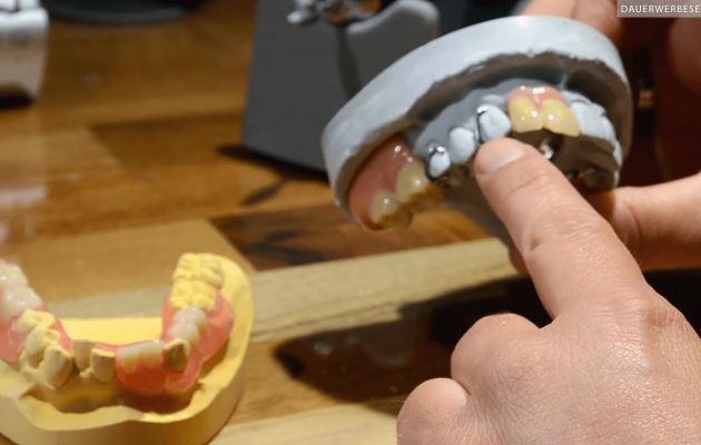 Zahnprothesen mit Kunststofftechnik